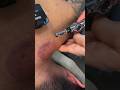 Dry needling with stim