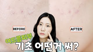 여드름 관리 어떻게 해?! /단종절대❌️템,티트리👍🏻, 예방을 잘하자! (클렌징부터 크림까지 싹 다 알려줌)