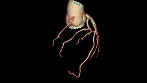 Thumbnail of UCSF Radiology: A Rotational View of the Cardiac CT Angiography