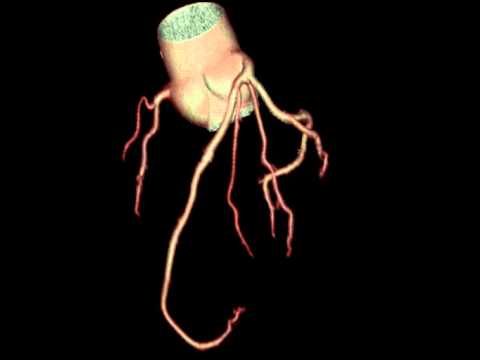 Video: Kas CTA on angiogramm?