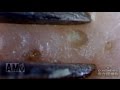 #03 Continuous Removal of Blackheads Close up - Squeezing Blackheads