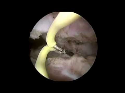 cirugia endoscopica de prostata
