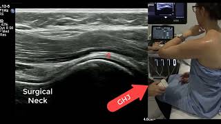 Live Scan Ultrasound Shoulder - Dynamic Rotator Cuff and Posterior Glenoid How to...