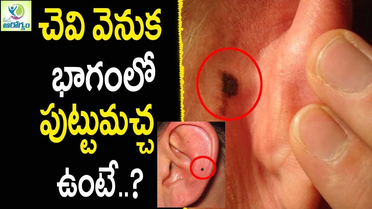 What Does it Mean When You Have a Mole on Your Ear ...
