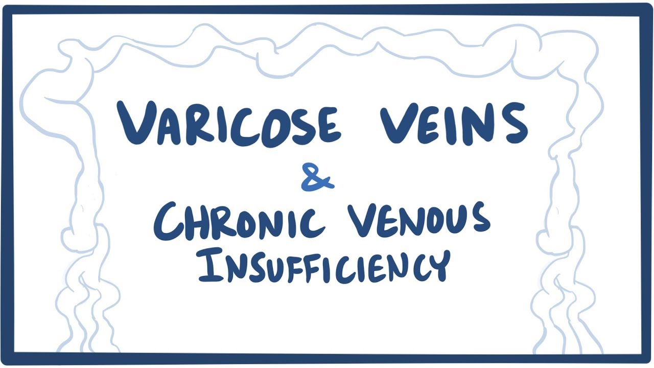 Varicose veins & chronic venous insufficiency (CVI) - an Osmosis Preview osmosis 会社