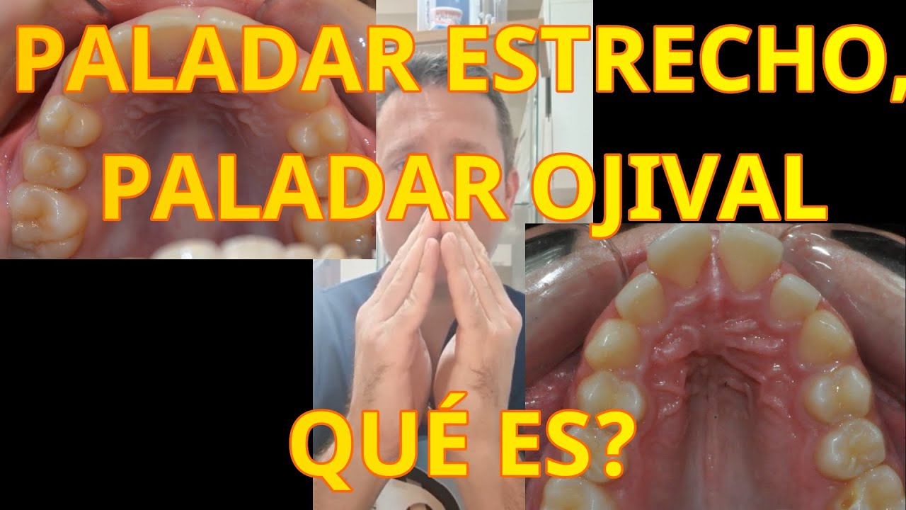 Paladar estrecho ¿qué es?, ¿qué problemas tiene? YouTube