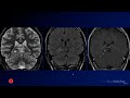 Neuroradiology Board Review - Brain Tumors - Case 16