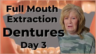 Immediate Denturs Full Mouth Extraction Day 3 and 4