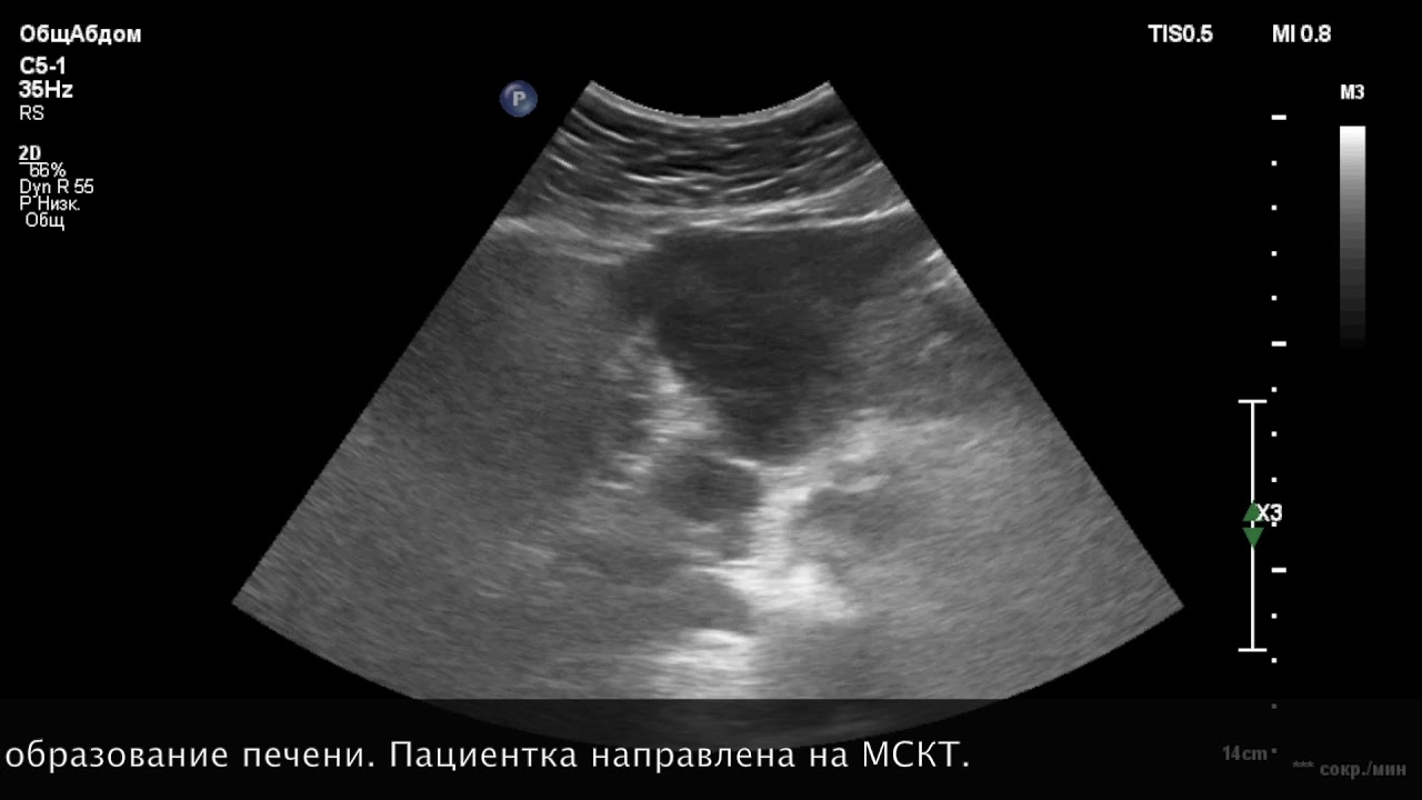 УЗИ печени. Объемное образование.