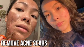 First Chemical Peel Experience! | Results Before & After screenshot 2