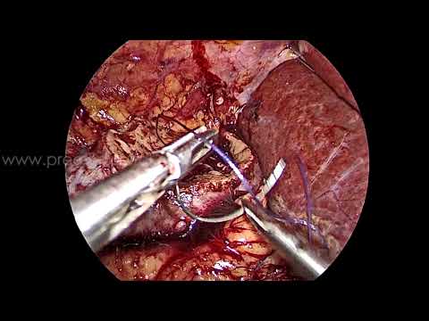 Laparoscopic Right Partial nephrectomy with WIT 30 mins Renal score 9x