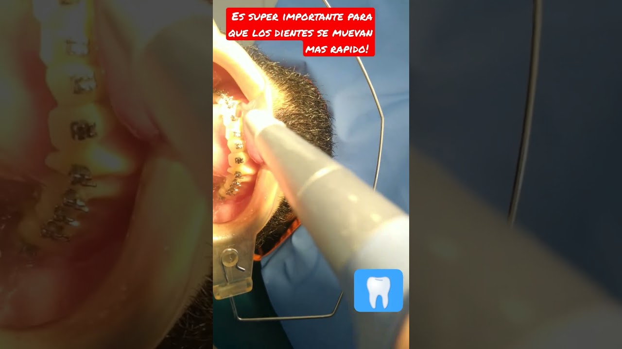 Huecos entre los dientes despues de una limpieza