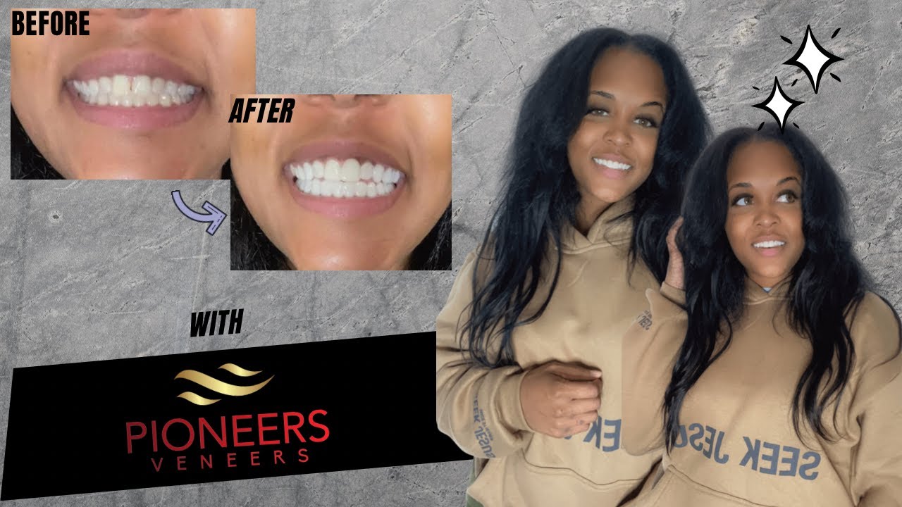 I Tried Snap On Veneers Affordable Veneers Pioneers Veneers Review
