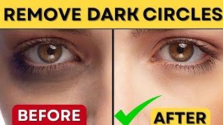 Naturally Reduce Dark Circles Around Eyes Expert Tips for Brighter Eyes | spots under eyes | Tips