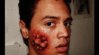 Gelatin prosthetic boils