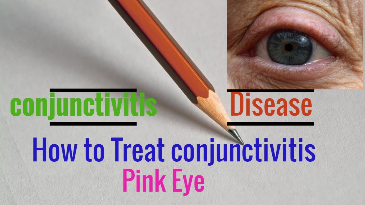 Conjunctivitis kya hota hai how to treat conjunctivitis Pink eye