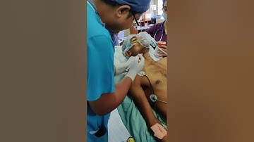 Airway blocks for awake nasotracheal intubation in 1 finger mouth opening.