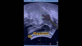 cervical fibroid 7.3x7.1x8.3cm #chongqing #ultrasounda #ablation #fibroids