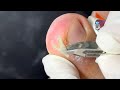 Ep_6545 Ingrown toenail removal 👣 อู้หู..ปากฉลาม 😄 (clip from Thailand)