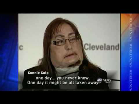 Face Transplant Recipient Shows Her Face | CONNIE ...