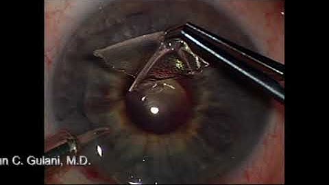 DASEK: Gulani Single Instrument, No-Stitch DSAEK