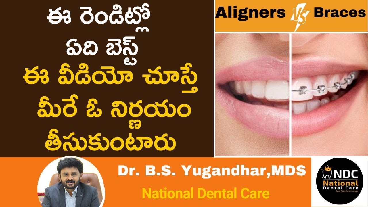 క్లిప్పులు, అలైనర్లలో మీకు ఏది మంచిదో తెలుసా || Aligners Vs Braces : Which Is Best Choice || NDC