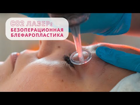 ЛАЗЕРНАЯ БЛЕФАРОПЛАСТИКА ВЕК БЕЗ ХИРУРГИЧЕСКОГО ВМЕШАТЕЛЬСТВА