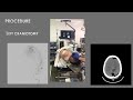 AANS Coding Shorts: Craniotomy for Resection of a Meningioma