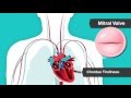 Understanding Heart Murmurs, Aortic and Mitral Valve Problems