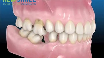 Hậu quả mất răng lâu ngày.