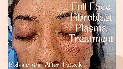 Fibroblast Plasma Skin Tightening Full Face [before and after]-sun spots, acne scars, etc
