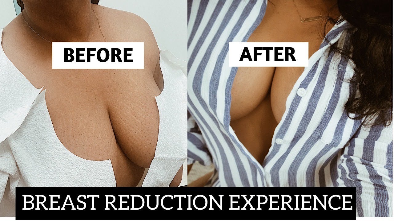 MY BREAST REDUCTION EXPERIENCE: HOW MUCH IT REALLY COST+MY REAL BRA SIZE & DID I REGRET IT