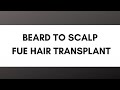 Beard to Scalp FUE Hair Transplant Q + A with Dr. Mohebi