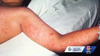 Measles concerns grow in Boston as FIFA World Cup visitors arrive