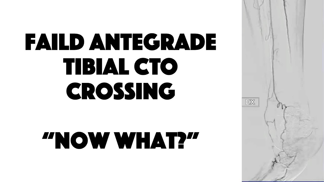 Failed Antegrade Tibial CTO Crossing: Now what?