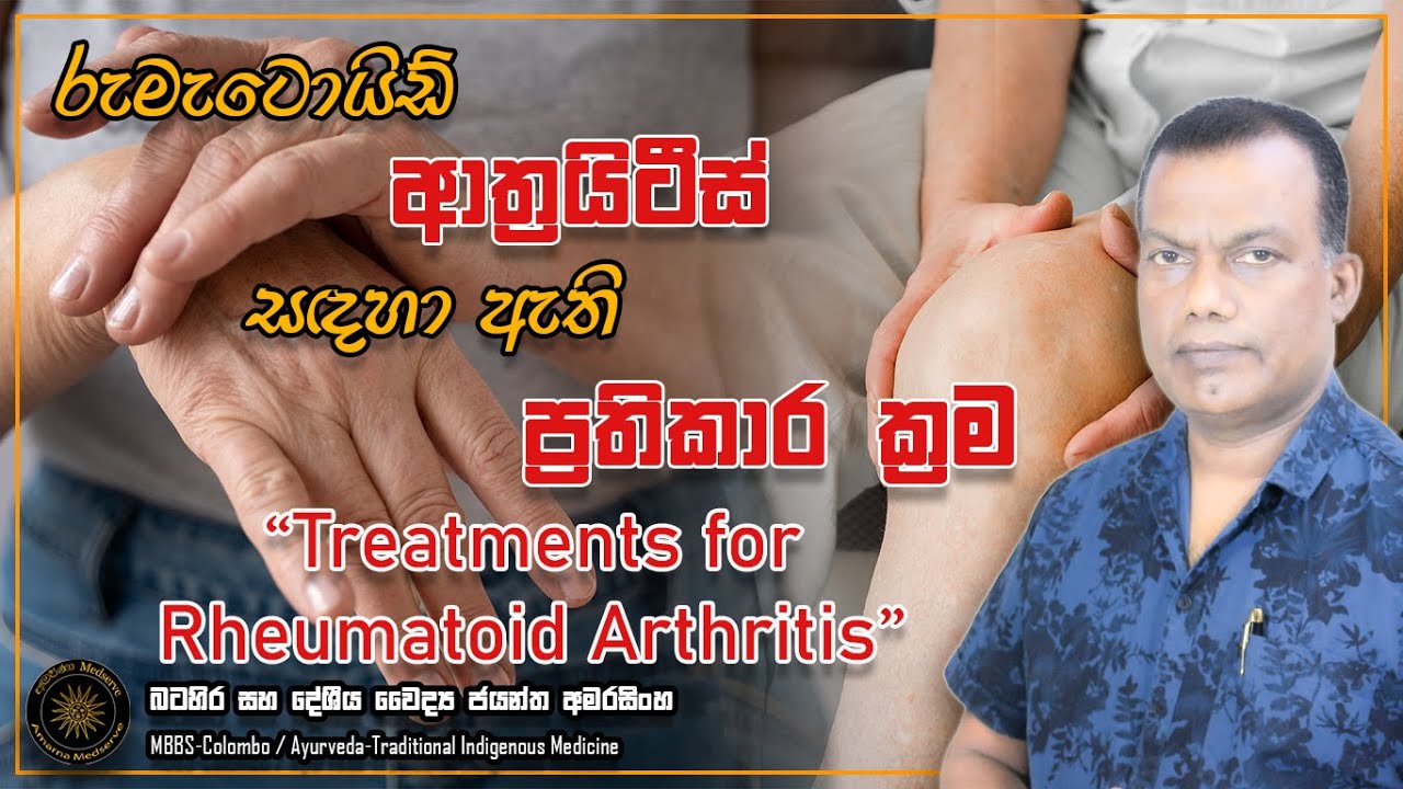 රුමැටොයිඩ් ආත්‍රයිටිස් රෝග තත්ත්වය සදහා ඇති ප්‍රතිකාර ක්‍රම | Treatments for Rheumatoid Arthritis