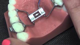 Activating the Palatal Expander