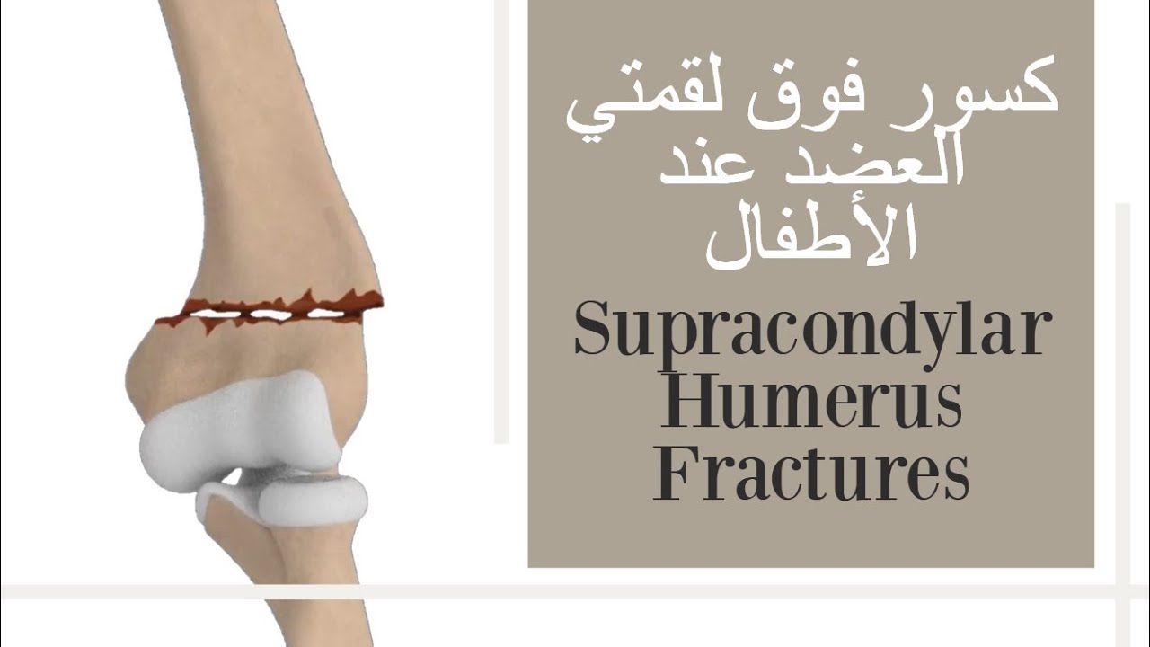 переломы локтевого сустава у детей - надмыщелковые переломы плечевой кости (с субтитрами)
