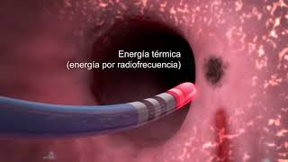 Derecha de ablación la vena pierna la de