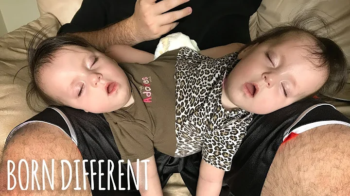 Conjoined Twins Are A Medical Miracle | BORN DIFFE...