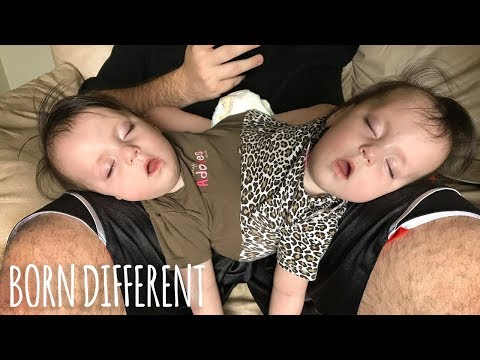 Conjoined Twins Are A Medical Miracle | BORN DIFFERENT