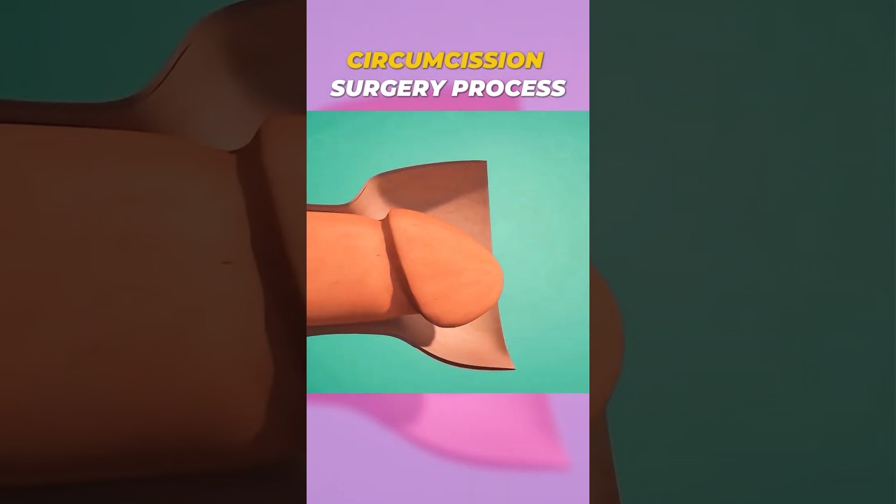 Circumcision Surgery Process | 3D Medical Animation in 60 Seconds 