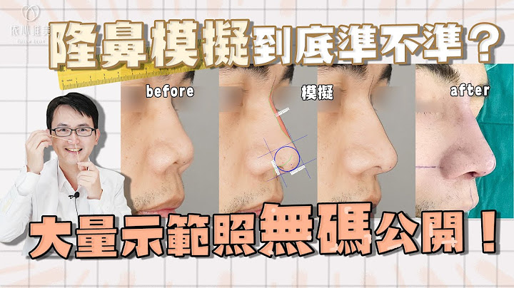 如何让隆鼻更加满意？术前模拟不可少！真实模拟对比公开｜依心唯美 谢东颖医师 - 天天要闻