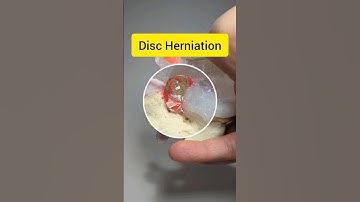 Disc Herniation Model by Dynamic Disc Designs #discherniation