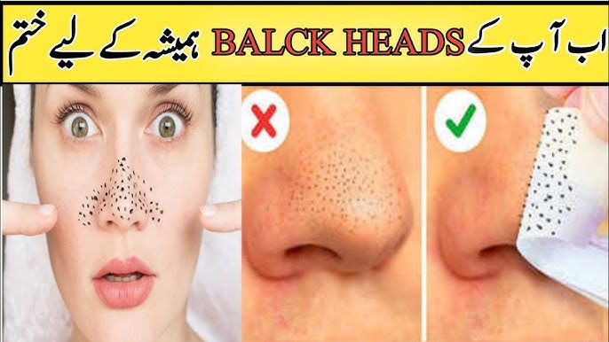 Effective Blackheads And Whiteheads 2024