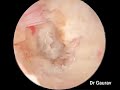 🎥 Exploring the Future of Spine Surgery: UBE (Unilateral Biportal Endoscopy)
