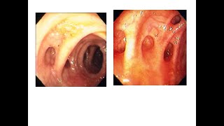 diverticular disease