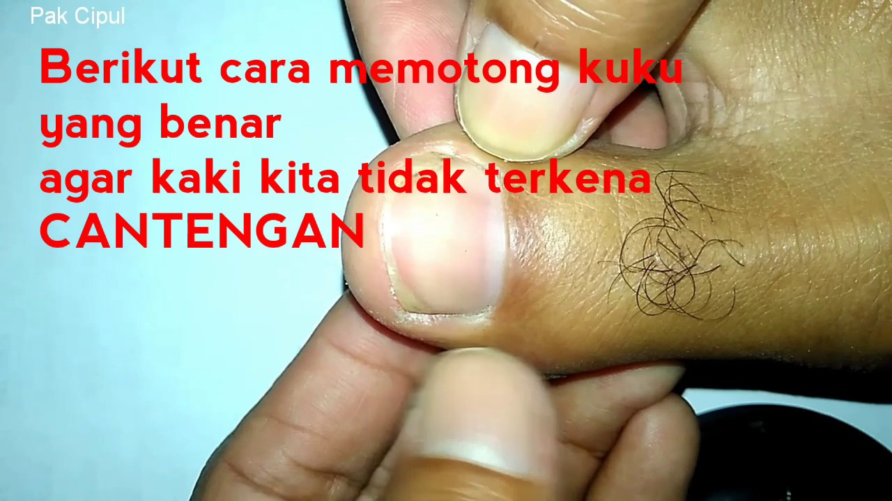 Cara mencegah cantengan pada kaki