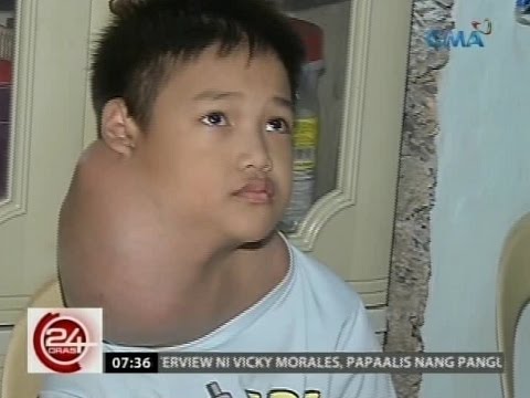 Video: Ang Inabandunang Aso Ay May Masakit 3.5 Pound Tumor Na Inalis Mula Sa Leeg