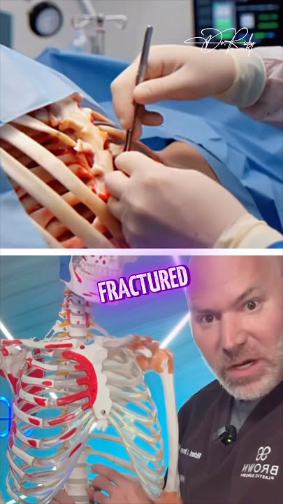 Removing Ribs? Here’s Why You Shouldn’t!
